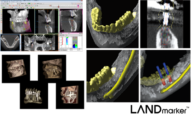高機能なインプラントシミュレーションソフト
